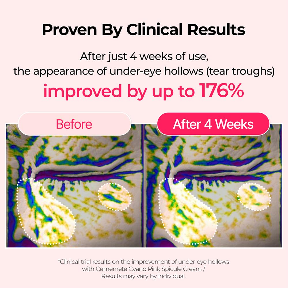 Dr.Melaxin Cyano Pink Spicule Cream clinical results under-eye hollows improved up to 176 percent