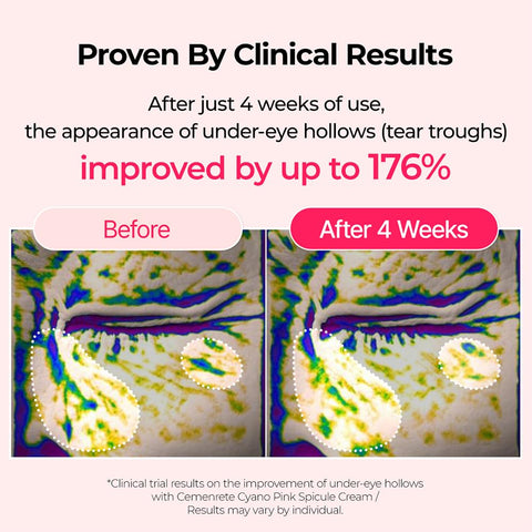 Dr.Melaxin Cyano Pink Spicule Cream clinical results under-eye hollows improved up to 176 percent