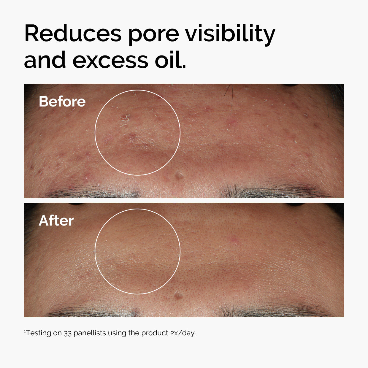 The Ordinary Niacinamide 10% + Zinc 1% Serum before and after pores