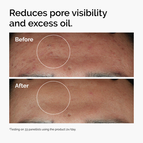 The Ordinary Niacinamide 10% + Zinc 1% Serum before and after pores